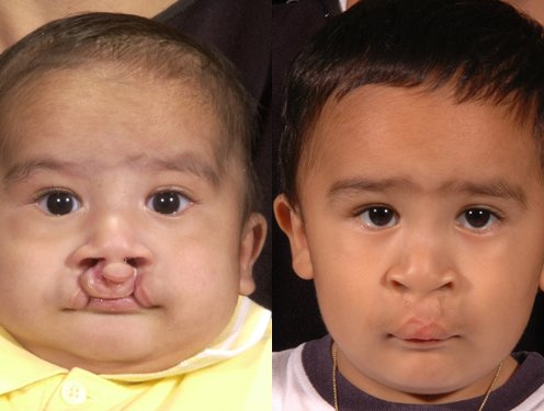 Cleft Lip / Palate Bilateral