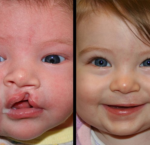 Cleft Lip Recontruction