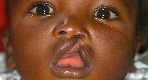 Home « European Cleft lip and