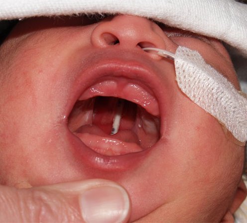 Cleft Palate