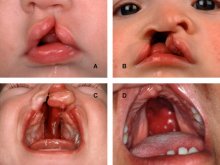 cleft lip and palate