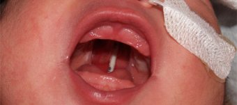 Picture of cleft palate