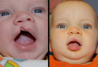 Cleft lip and Palate Repair