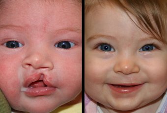 Cleft palate surgery cost