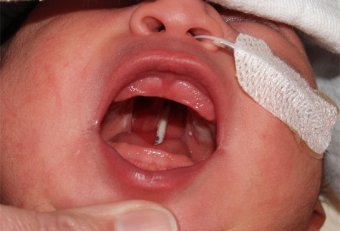 Picture of cleft palate